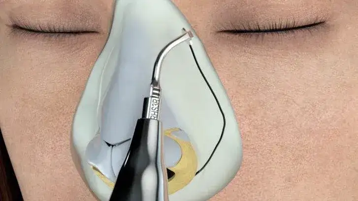 Cómo funciona la rinoplastia ultrasónica y dónde realizarla en Tandil.