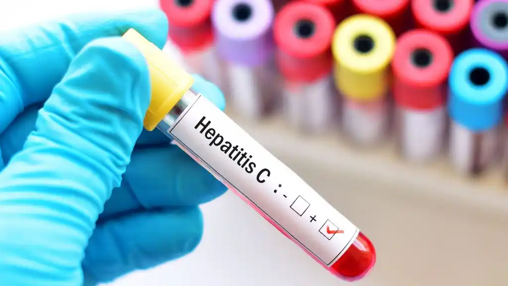 El testeo es la única forma de saber si alguien tiene hepatitis C