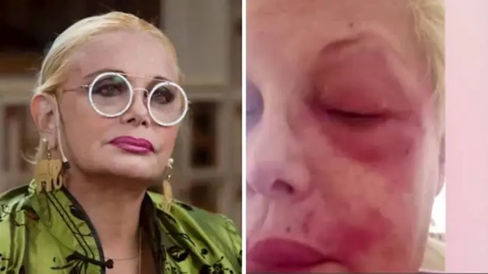 Carmen Barbieri atraviesa un mal momento de salud: "Puedo perder un ojo"