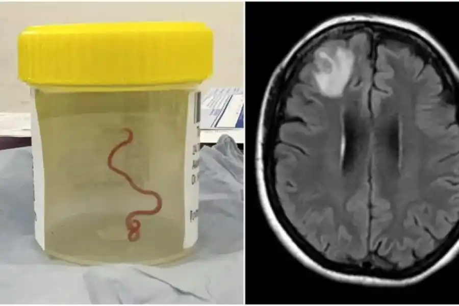 Científicos descubren por primera vez en el mundo un gusano parásito en el cerebro de una mujer
