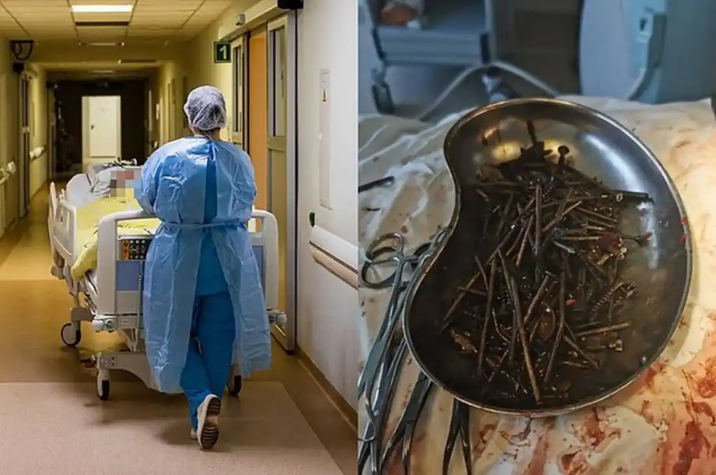 Insólito: un hombre tenía más de un kilo de clavos y tornillos en su estómago