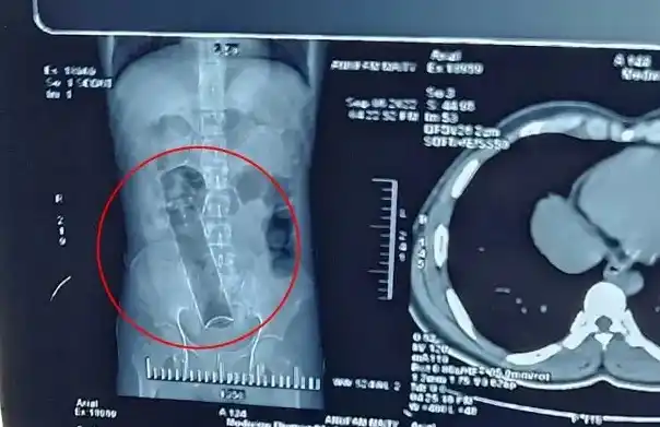 Joven estuvo tres semanas con un desodorante de 20 centímetros en el ano