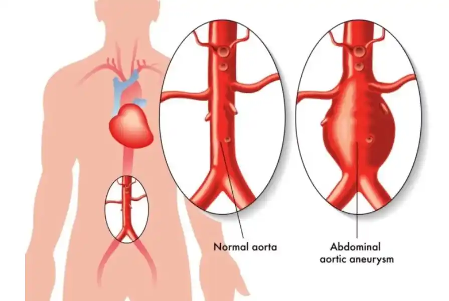 Campaña gratuita de detección de Aneurisma de Aorta Abdominal