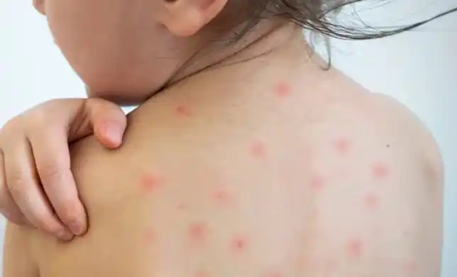 Sarampión en Provincia de Buenos Aires: Nuevas recomendaciones de vacunación