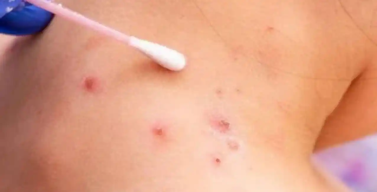 Argentina: confirmaron el séptimo caso de viruela del mono