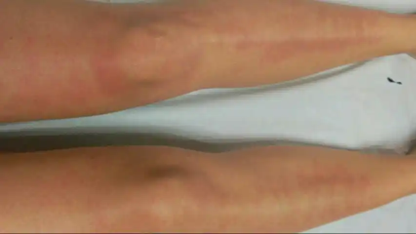 depilacion definitiva quemadura