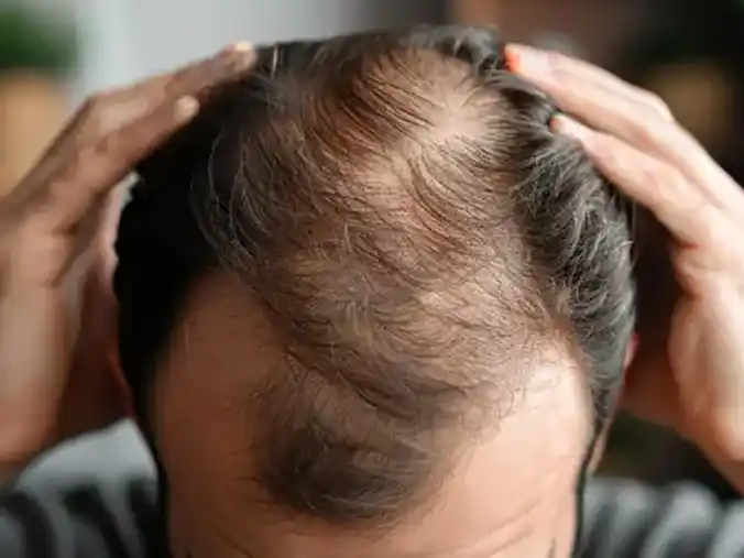 SALUD: Células madre para la alopecia. La terapia que reactiva folículos y revertiría calvicie en hasta un 100%