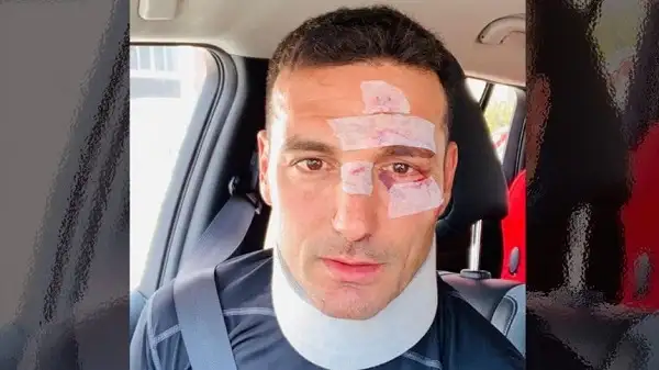 Scaloni sufrió un accidente en España y tuvo lesiones en la cara