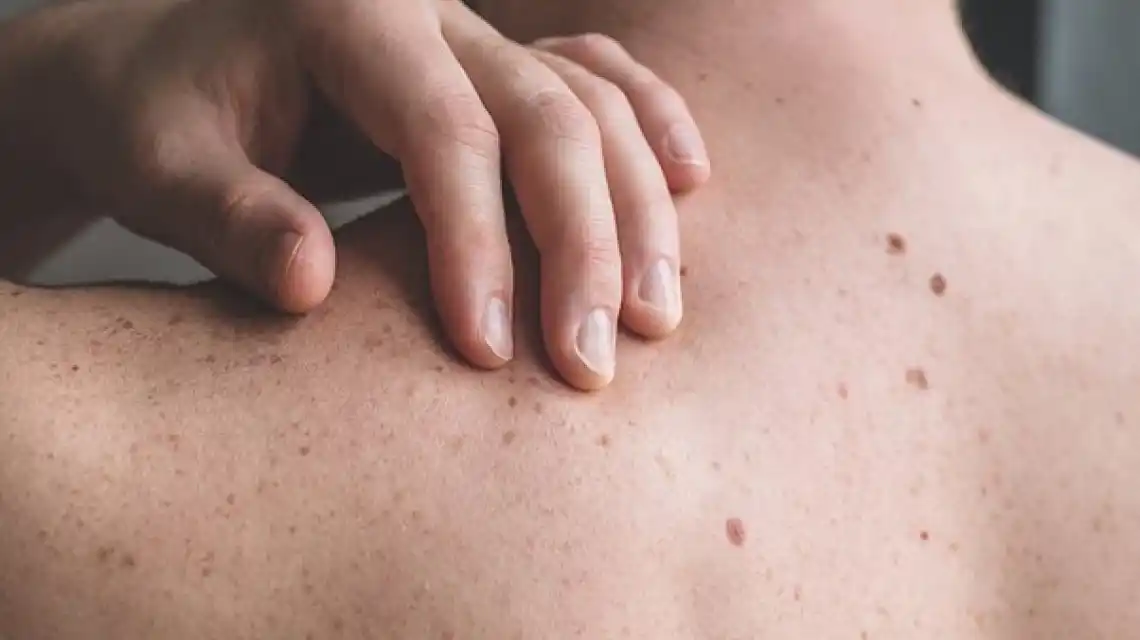 Día Mundial del Melanoma: la importancia de sostener cuidados del sol