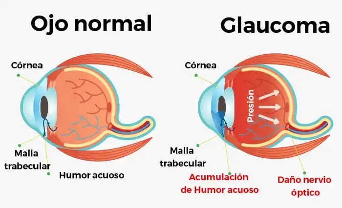 glaucoma - 2