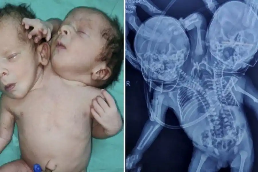 Increíble: nació un bebé con dos cabezas y tres brazos y no saben si podrán "separarlos"