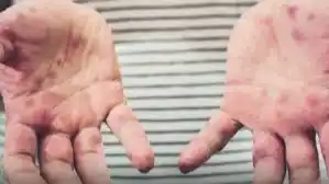 Cuarenta y cuatro casos de personas con sarampión