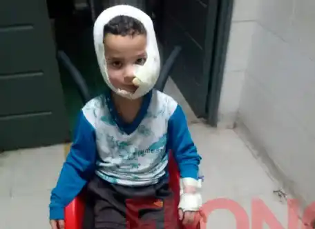 El chiquito que fue mordido por un perro necesitará unas 10 cirugías de reconstrucción