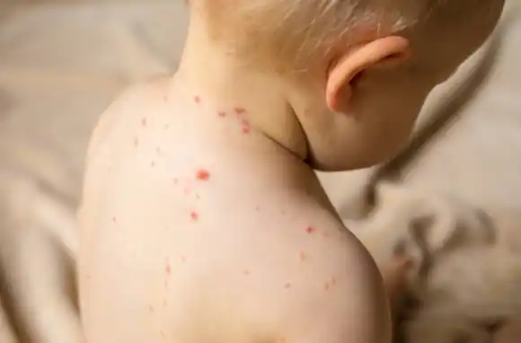 Desde el próximo año, la vacuna contra el sarampión se aplicará a los 18 meses