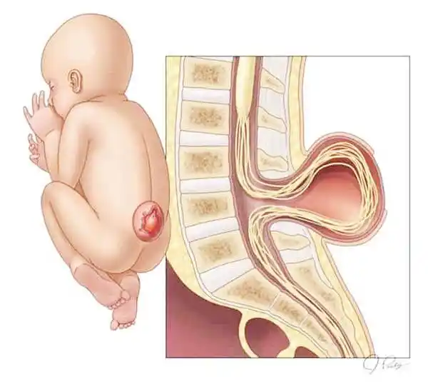 Espina bífida: primer tratamiento con células madre