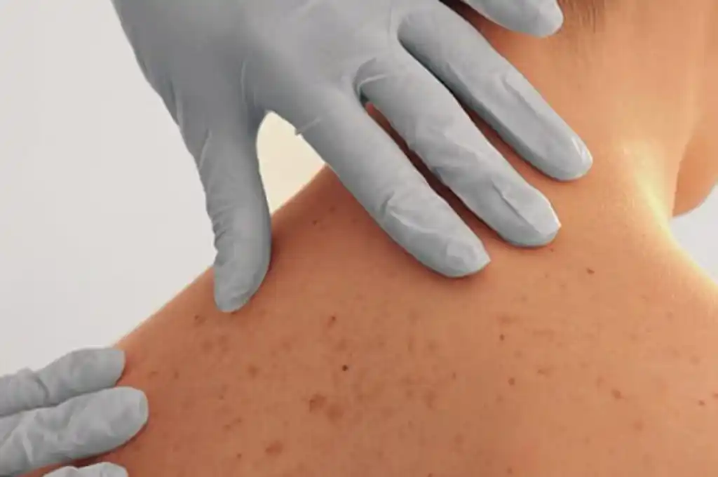 Investigadores descubrieron que el COVID-19 puede generar daños en la piel