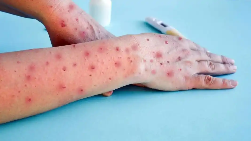 El paciente, sin antecedentes de haber viajado al exterior, quedó aislado en su domicilio hasta que responda al tratamiento.