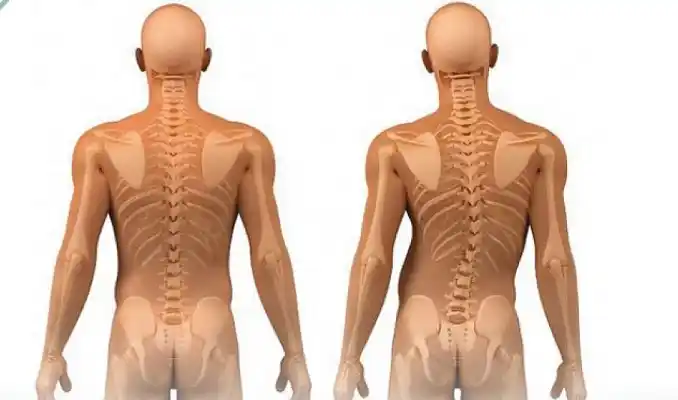 Escoliosis: ¿los ejercicios terapéuticos tienen que formar parte del tratamiento?