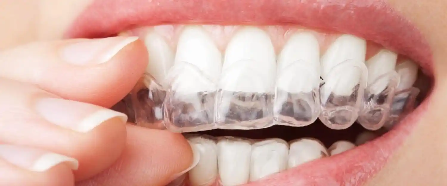 ¿Qué dice el bruxismo sobre tu estado mental y por qué mucha gente no sabe que lo tiene?