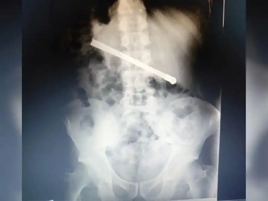 La impactante imagen de la placa radiográfica del interno de la cárcel.