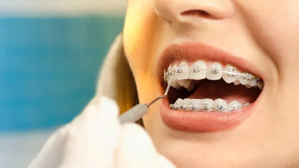 La comercialización y la distribución de una partida de brackets para ortodoncia falsificados