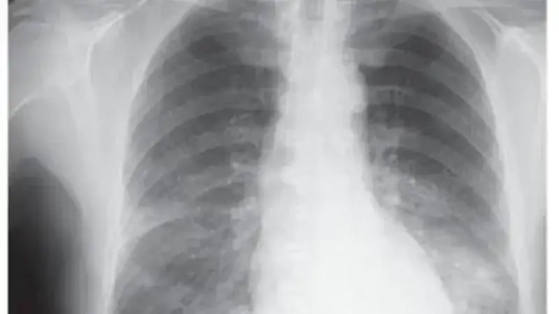 Qué es un adenocarcinoma pulmonar, la enfermedad respiratoria que tiene el papa León XIV