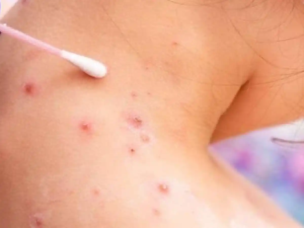 Primer caso de viruela del mono en Córdoba 