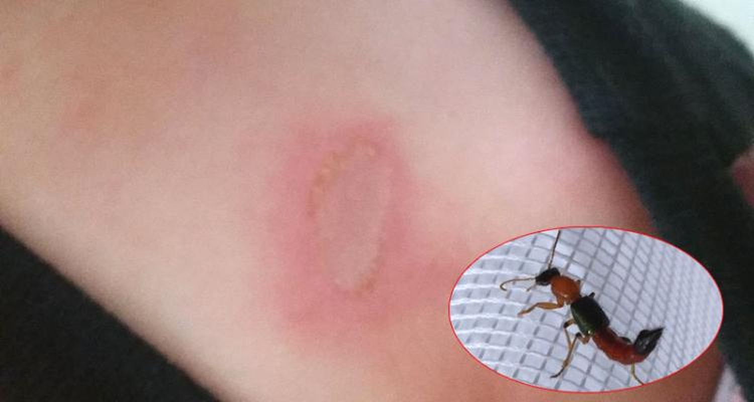 Epidemia: Aumentan los casos por dermatitis causado por el Paederus