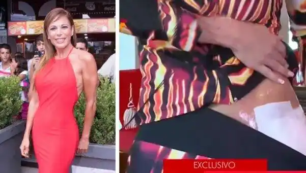 Iliana Calabró se quemó con agua hirviendo
