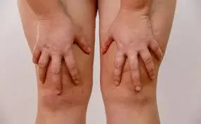 ¿TIENES GRASA EN LAS PIERNAS? Te contamos cómo rebajarlas
