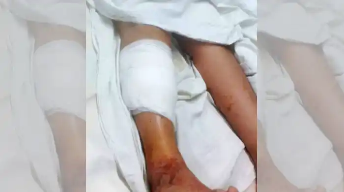 Bahía Blanca: Un pitbull mordió a un nene y le arrancó parte de su pierna