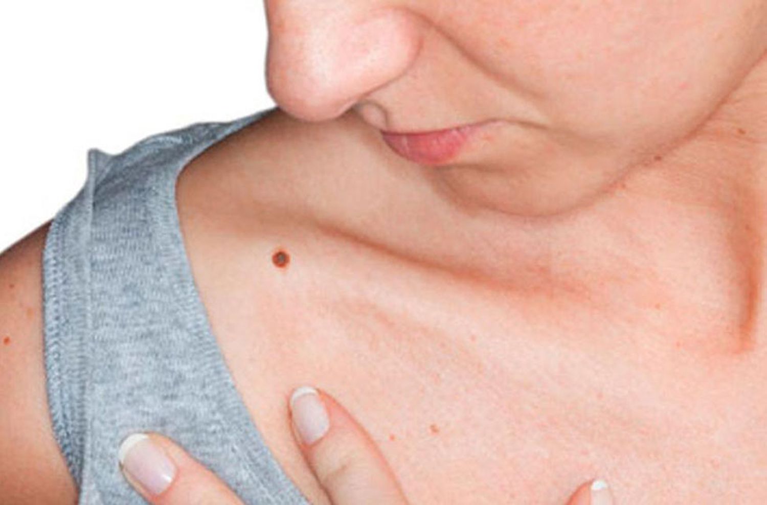 Cáncer de piel: cuatro de cada cinco casos se pueden prevenir