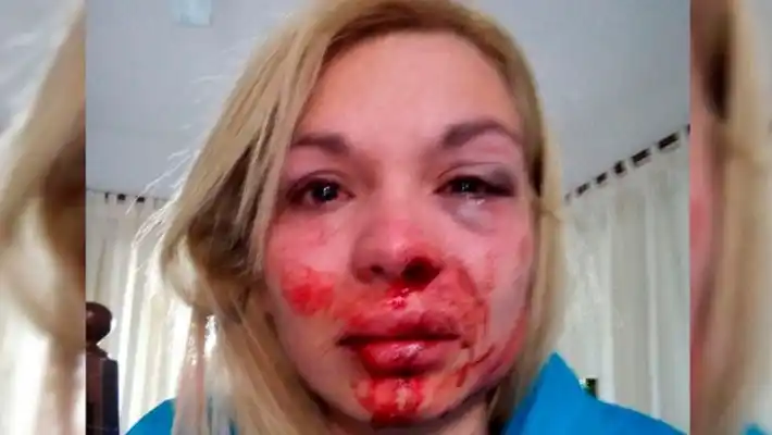 Sufrió una brutal golpiza de su pareja: "Me quiso tirar por las escaleras"