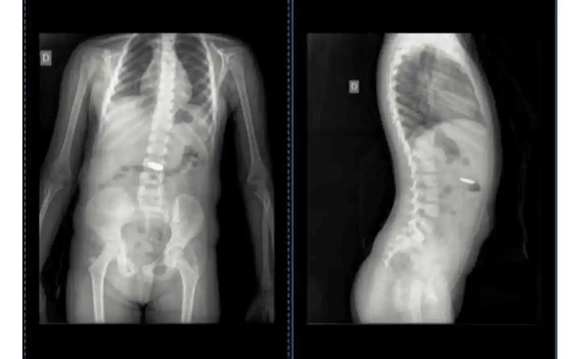 Una madre de Chascomús comunicó en redes sociales que debió consultar a 7 médicos para constatar que su hija se había tragado una pila