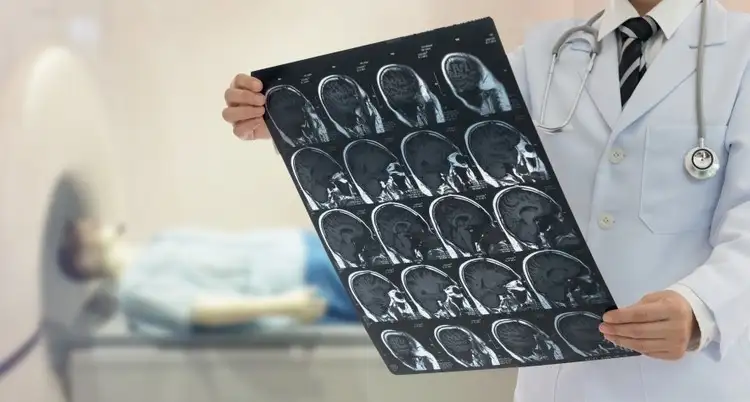 El ataque cerebral constituye la segunda causa de muerte y la primera de discapacidad a nivel mundial.