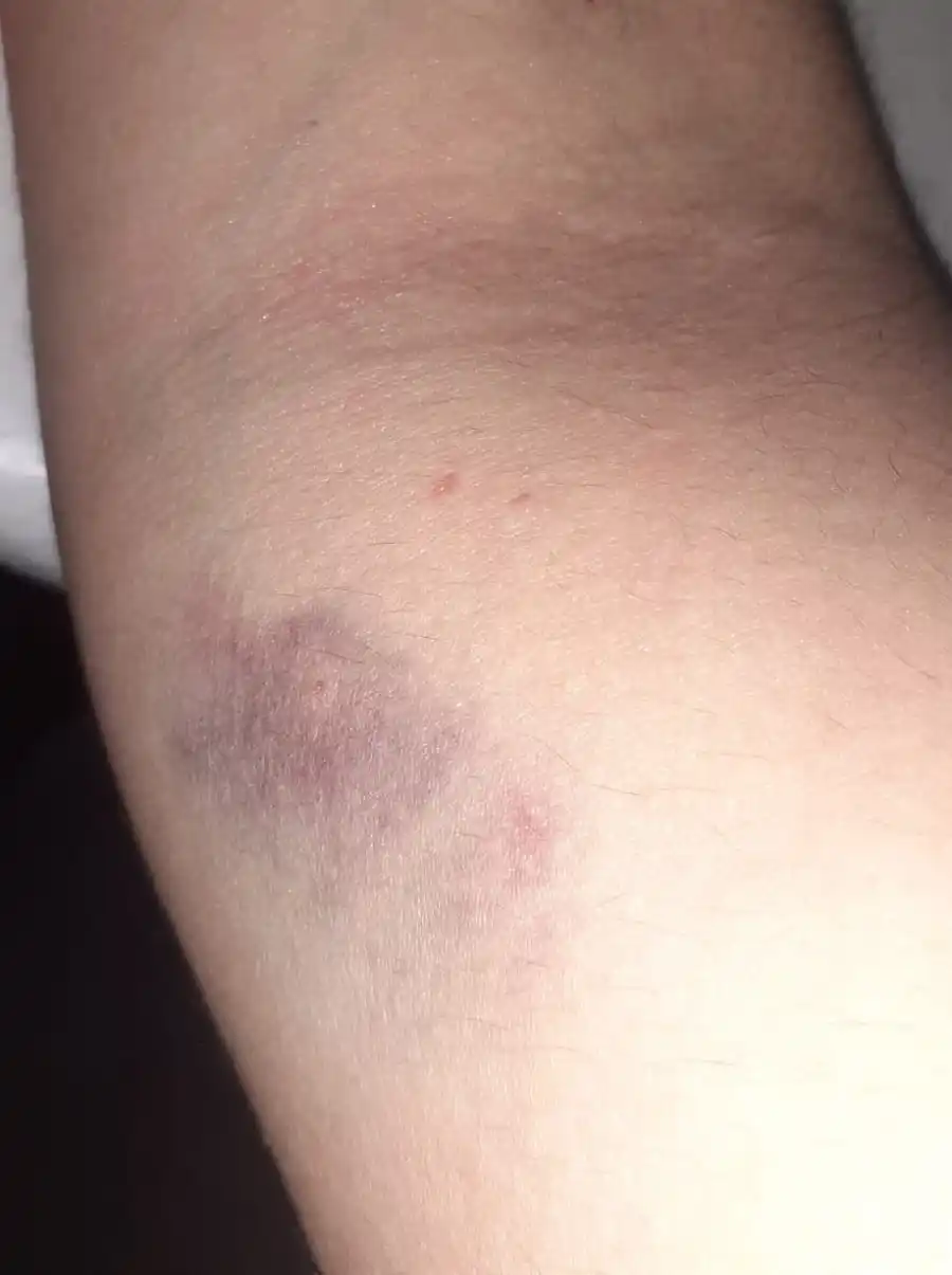 La queja por los hematomas que le quedaron tras ser asistidas en el Hospital.