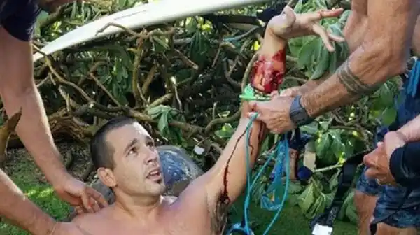 Impactantes imágenes del argentino que sobrevivió al ataque de un tiburón 