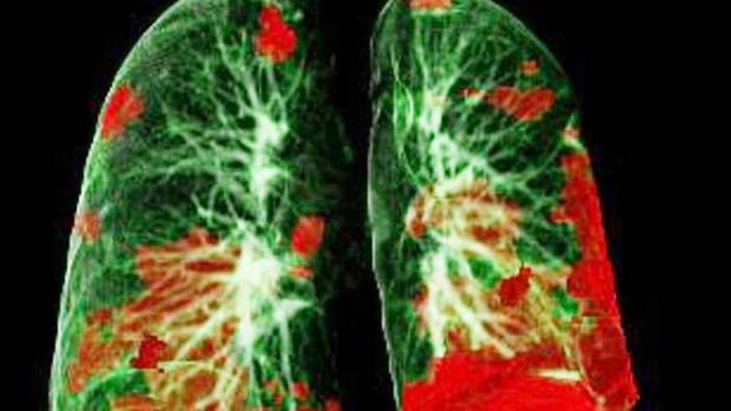 COVID-19: el daño pulmonar y cardíaco mejora con el tiempo