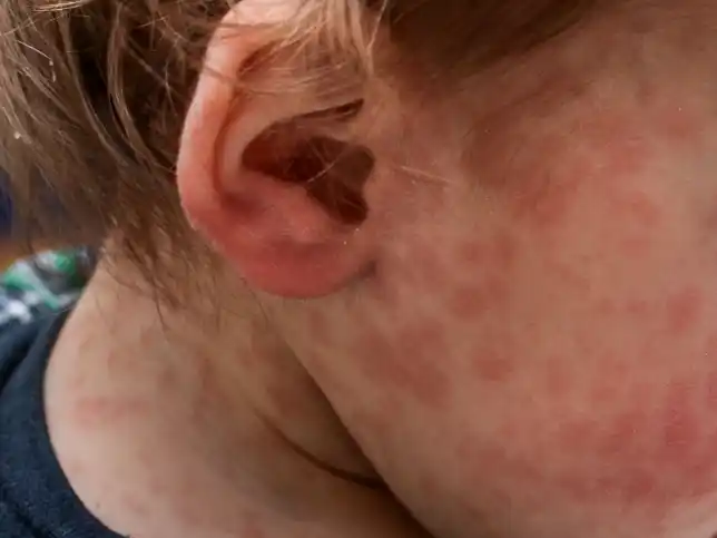 Confirmaron un caso de Sarampión en Entre Ríos y Salud provincial convocó a una comisión de vigilancia