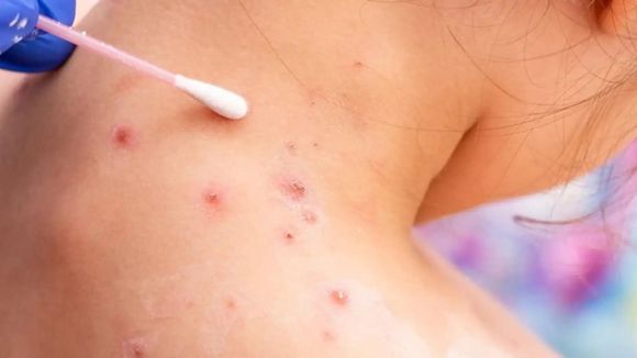 ¡ALERTA! Confirman  2 casos de viruela del mono en Venezuela