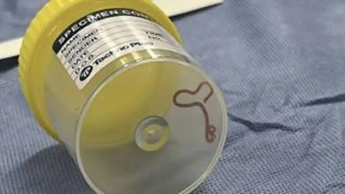 Retiran del cerebro de una mujer  en Australia, lombriz parasitaria que era común solo en canguros y pitones