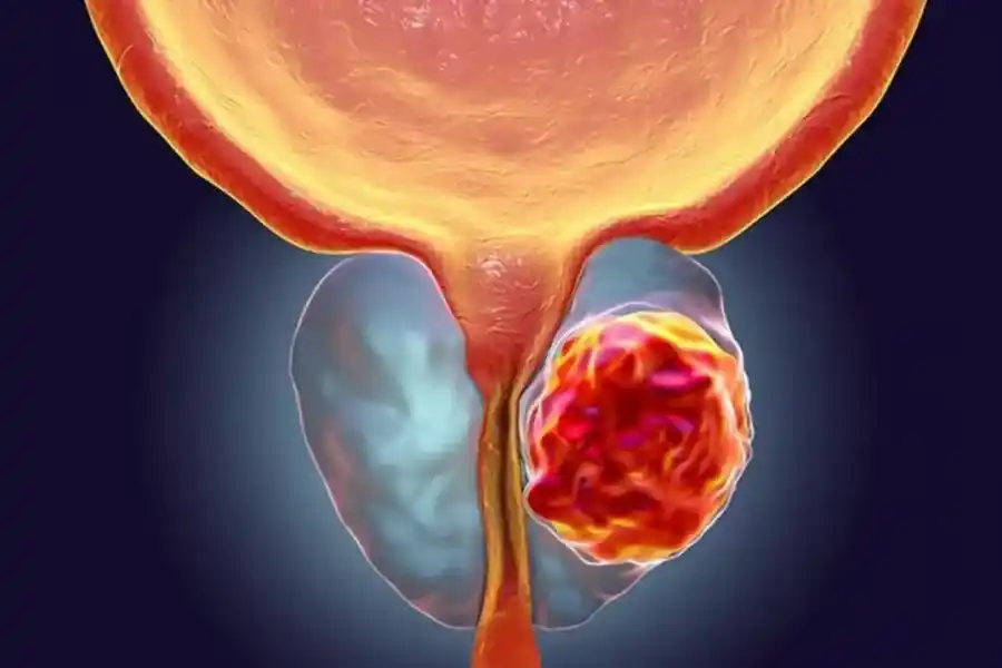 Cáncer de próstata: en la provincia se diagnostican 760 casos nuevos al año