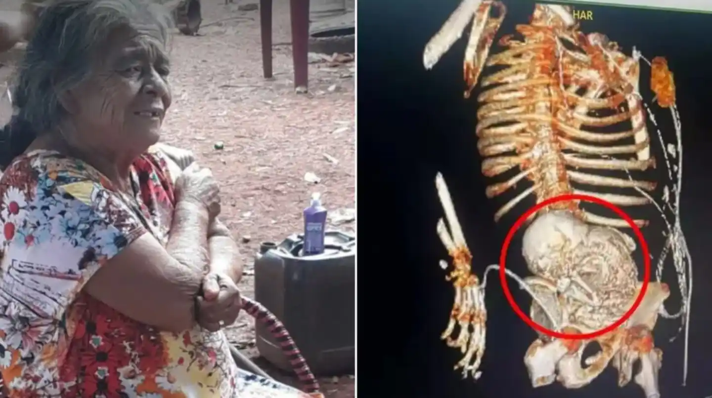 La mujer llevaba en su cuerpo un feto calcificado, una condición conocida como litopedia.