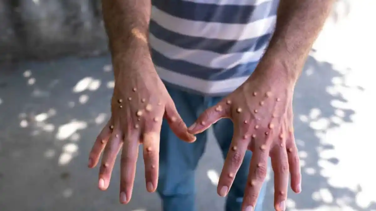 Primer caso de viruela sísmica en la ciudad de Santa Fe