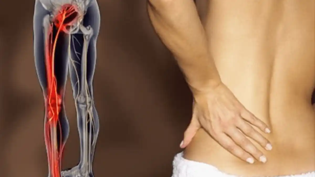 Dolor lumbar y calambres en la pierna:  ¡Cuidado puede ser la ciática!