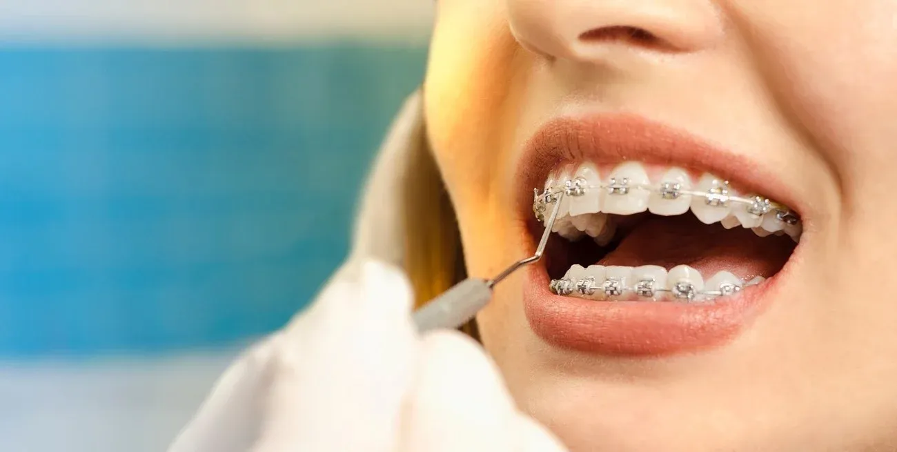 La comercialización y la distribución de una partida de brackets para ortodoncia falsificados