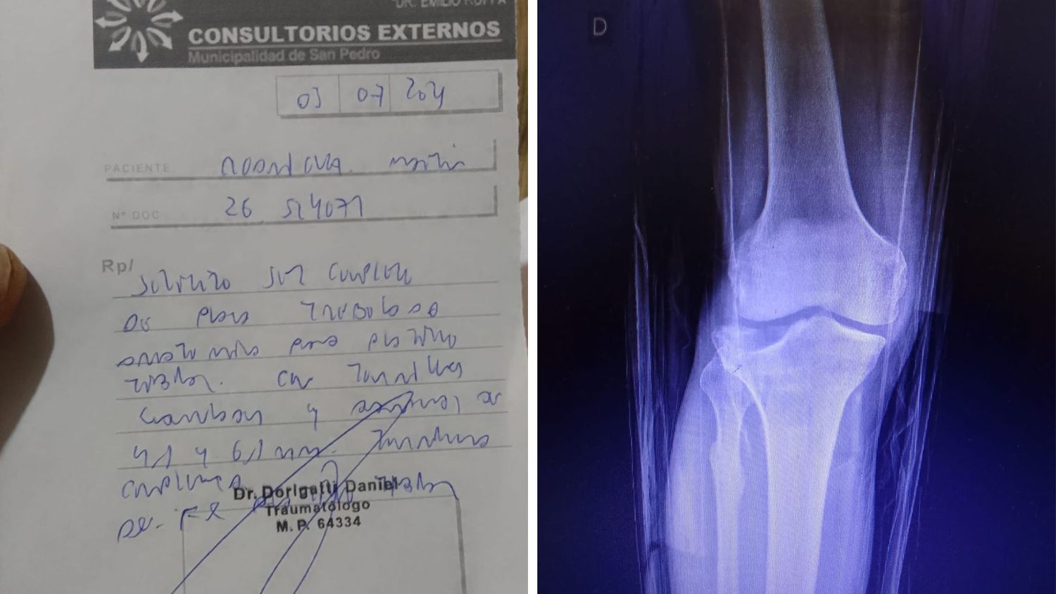 Martín necesita dinero para comprar una prótesis de rodilla