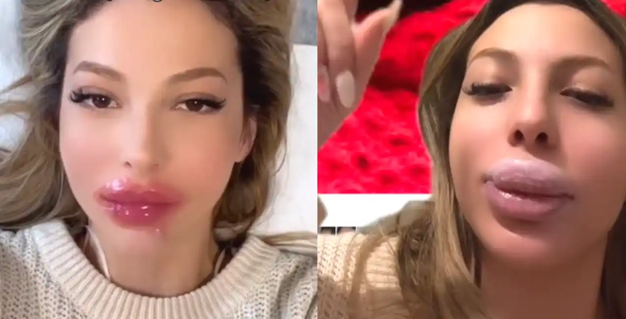 El increíble antes y después de una joven que se inyectó los labios y se le deformaron.