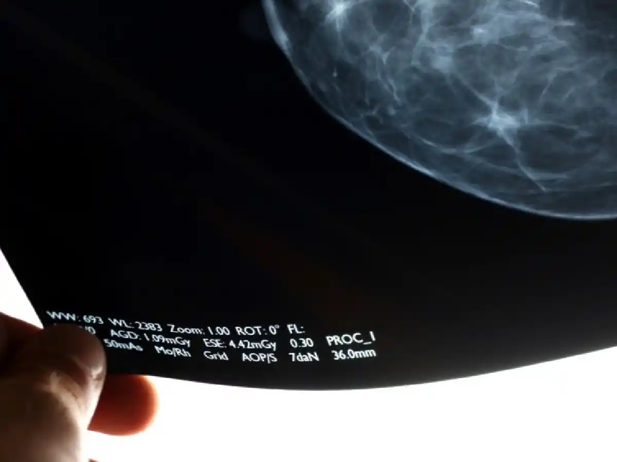 Cuáles son los tres tipos de cáncer más letales en la Argentina