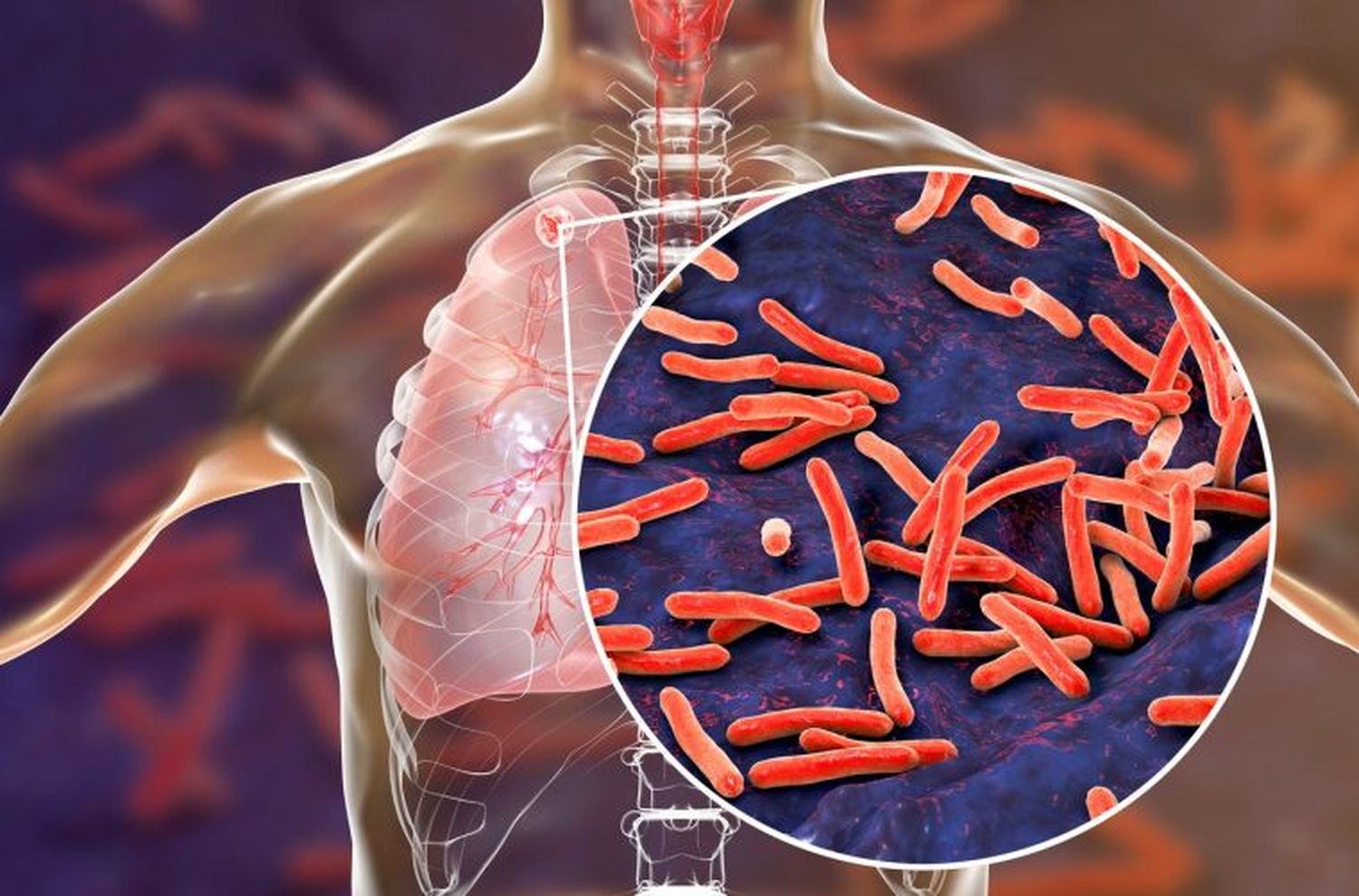 Crecieron los casos de tuberculosis en la Argentina
